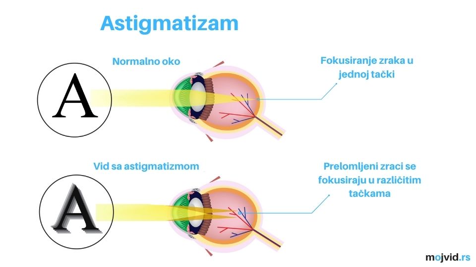 astigmatizam slike