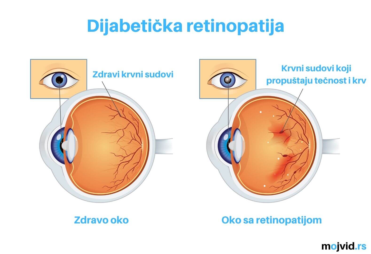 dijabetička retinopatija slike